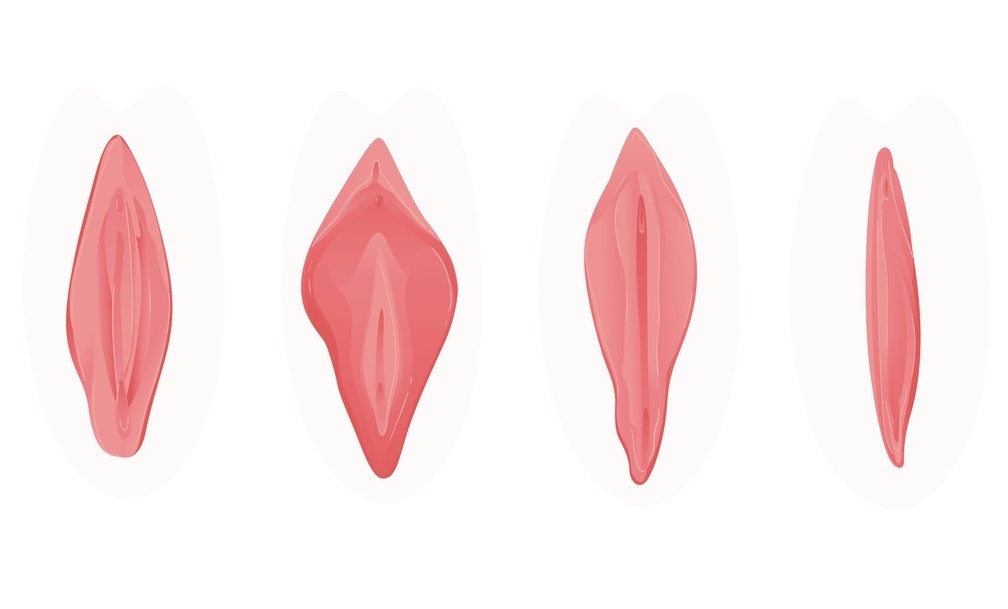 Cirurgia Íntima Funcional (Ninfoplastia), Dra. Andressa Lacerda